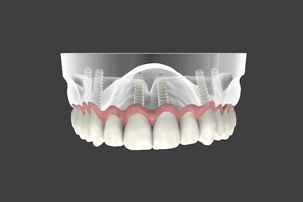 Are Implant Supported Dentures Permanent from Gregory Zabek Advanced General & Cosmetic Dentistry in San Francisco, CA