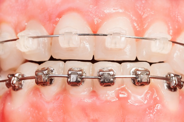 How To Care For New Clear Braces