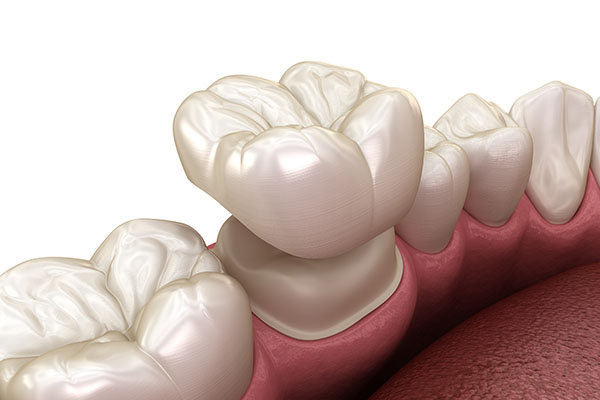 What Can Dental Crowns Do for Your Oral Health Issues? from Gregory Zabek Advanced General & Cosmetic Dentistry in San Francisco, CA