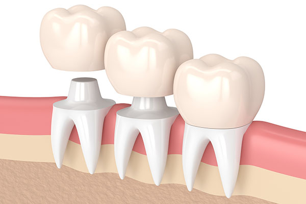 Three Tips to Deal With a Loose Dental Crown from Gregory Zabek Advanced General & Cosmetic Dentistry in San Francisco, CA