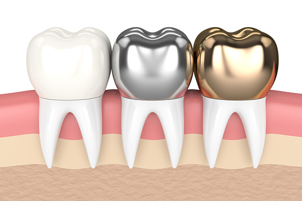 Metal Crowns vs. Porcelain Dental Crowns from Gregory Zabek Advanced General & Cosmetic Dentistry in San Francisco, CA
