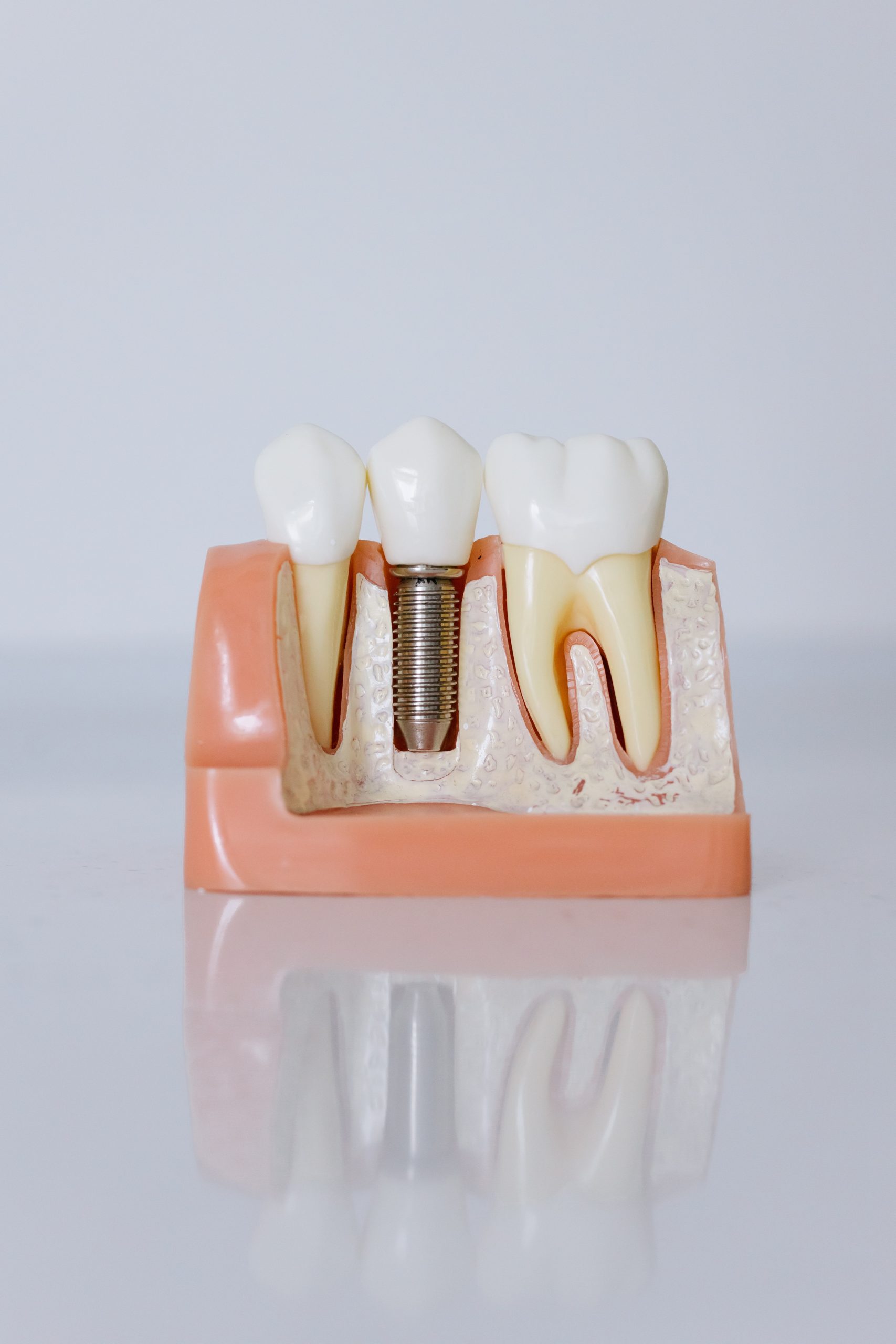 Are You A Candidate For Dental Implants? Discovering Your Path To A Lasting Smile