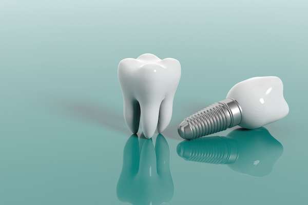 Questions To Ask Your Implant Dentist