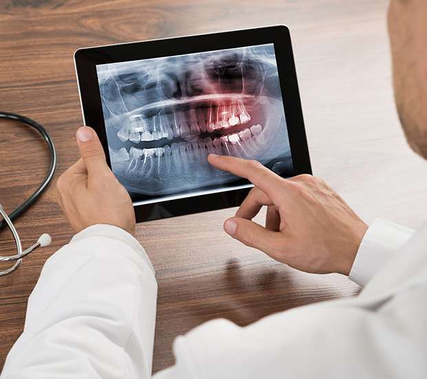 San Francisco Types of Dental Root Fractures