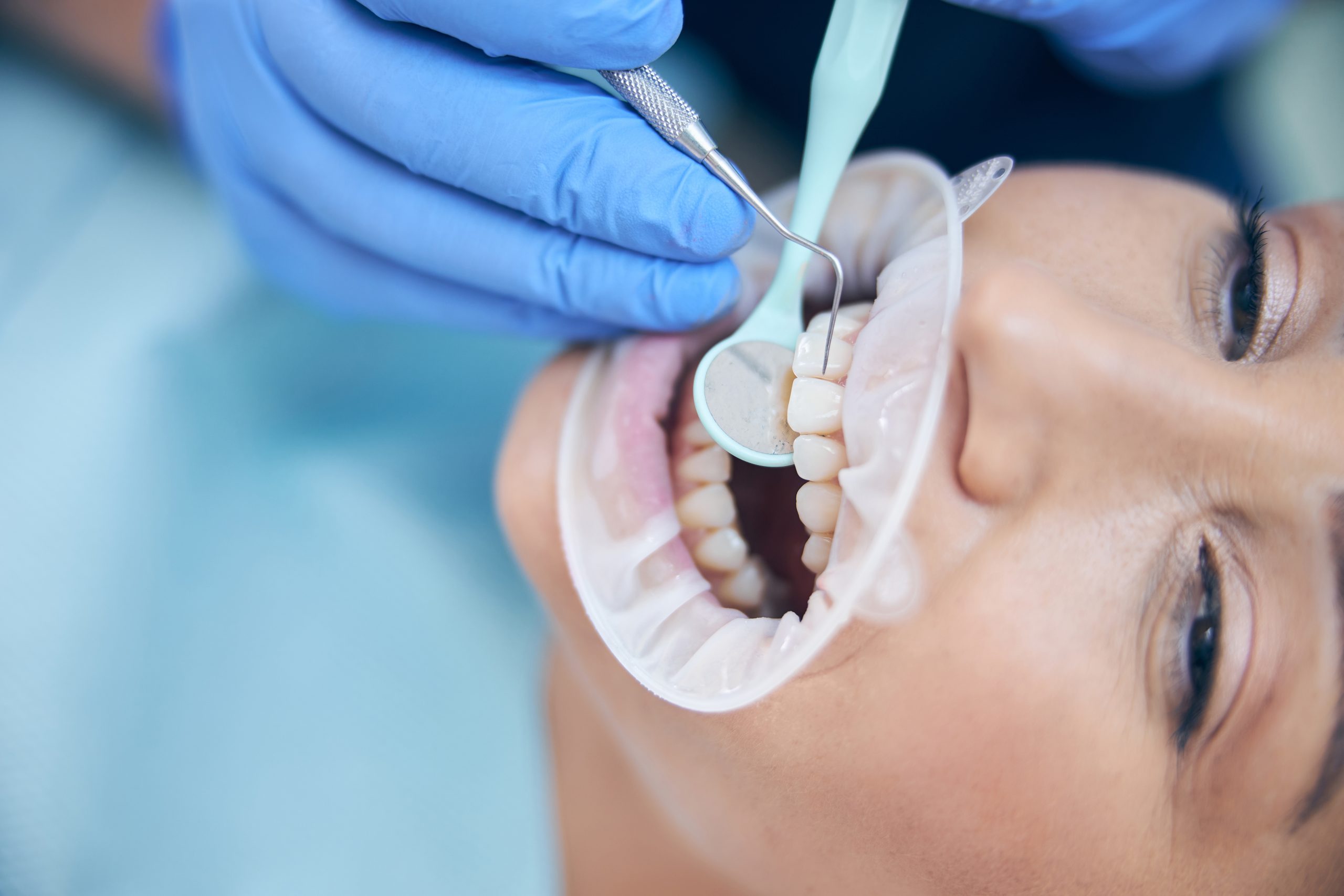 Chipped A Tooth While On Vacation In San Francisco? We Can Help